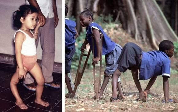 Emlash — Poliomiyelitga Qarshi Yagona Himoya