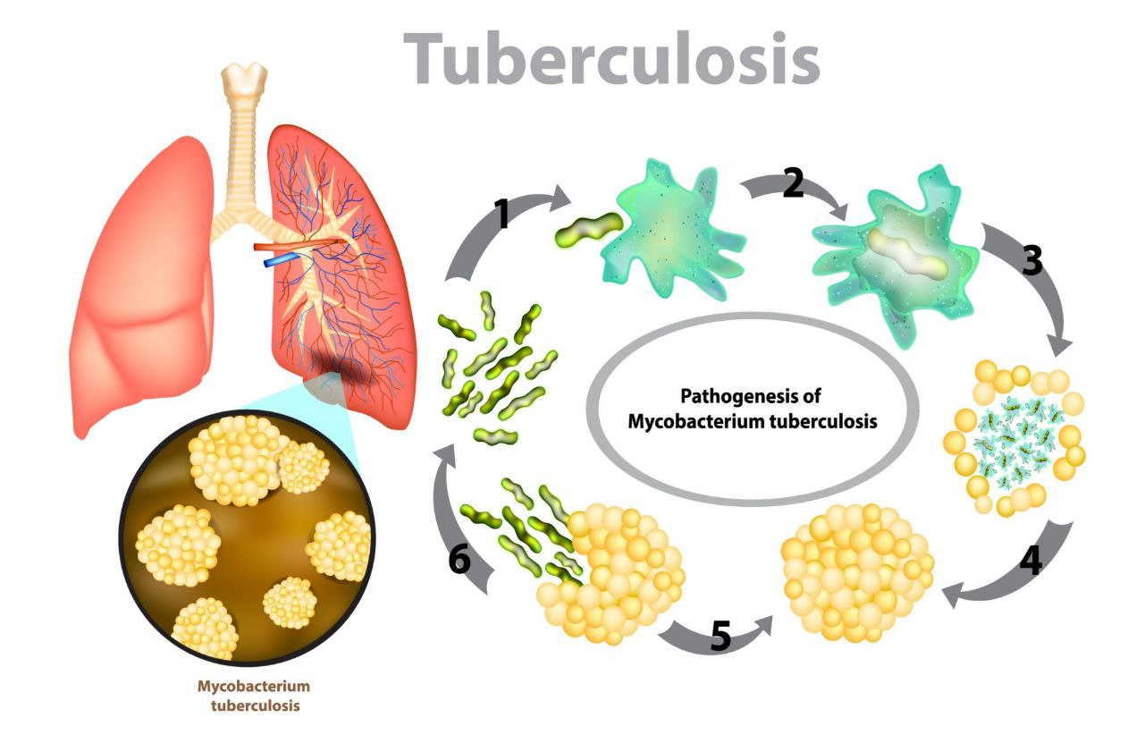 Sil kasalligi profilaktikasi