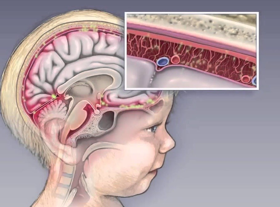 ❗️Meningit - yuqori o'lim ko'rsatkichiga ega xavfli kasallik